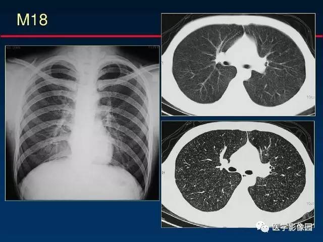 血行播散性肺结核的影像表现及鉴别诊断影像天地