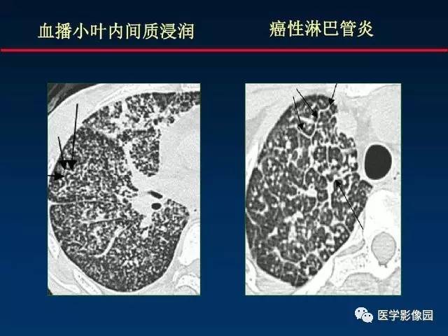 慢性血行播散型肺结核图片