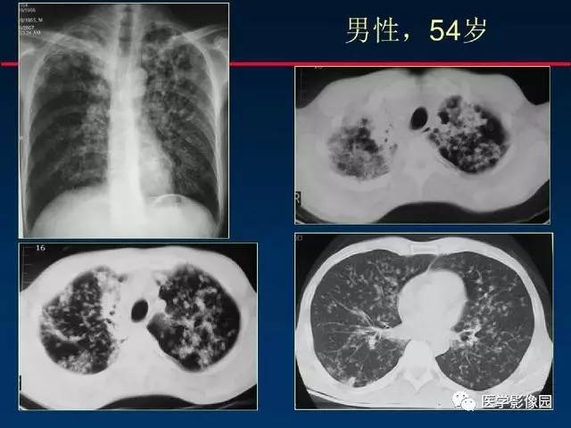 慢性血行播散型肺结核图片