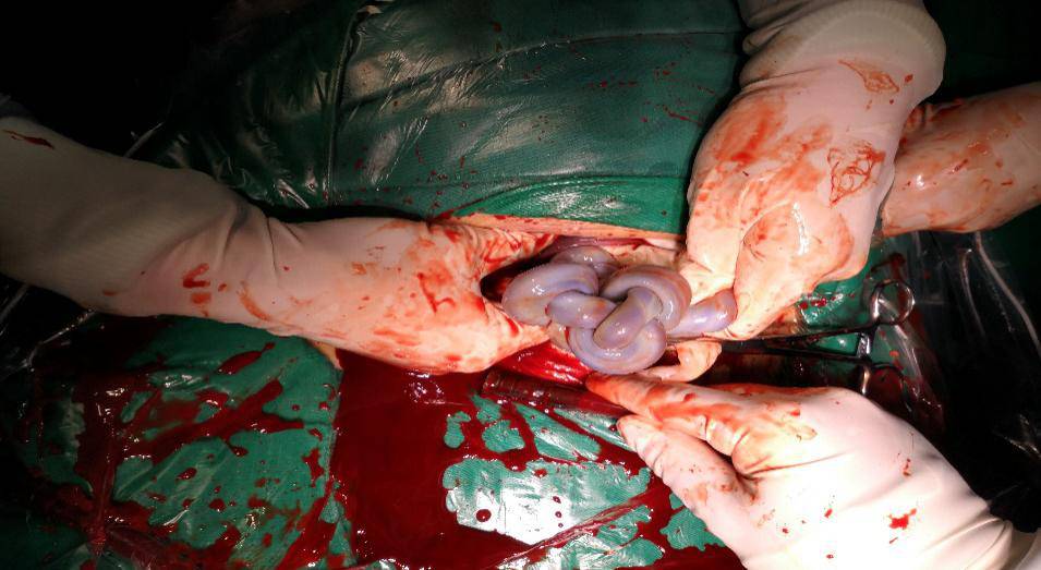 胎儿宫内脐带死结照片图片