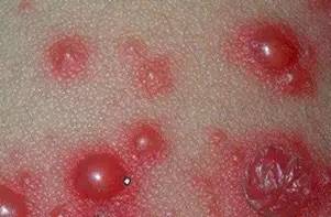 女性肛周带状疱疹图片