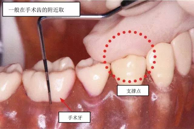 【牙周治疗笔记】学习牙周基础治疗之探针