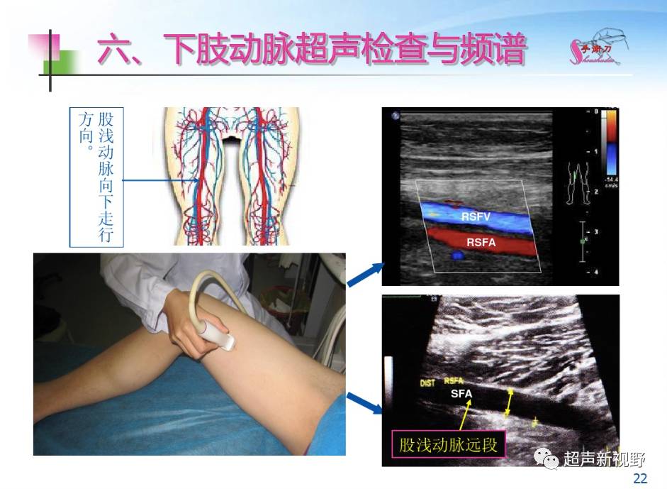 科普| 下肢血管的超聲檢查與正常聲像圖