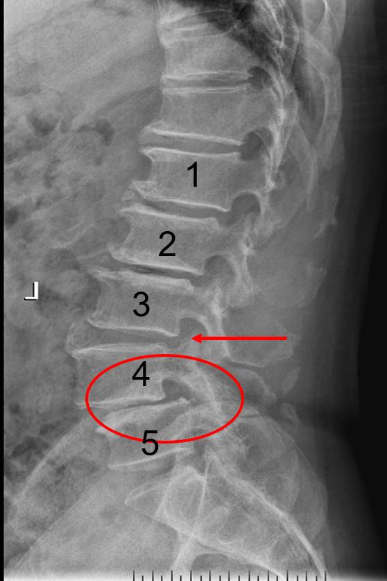 l3s1椎间盘位置图图片