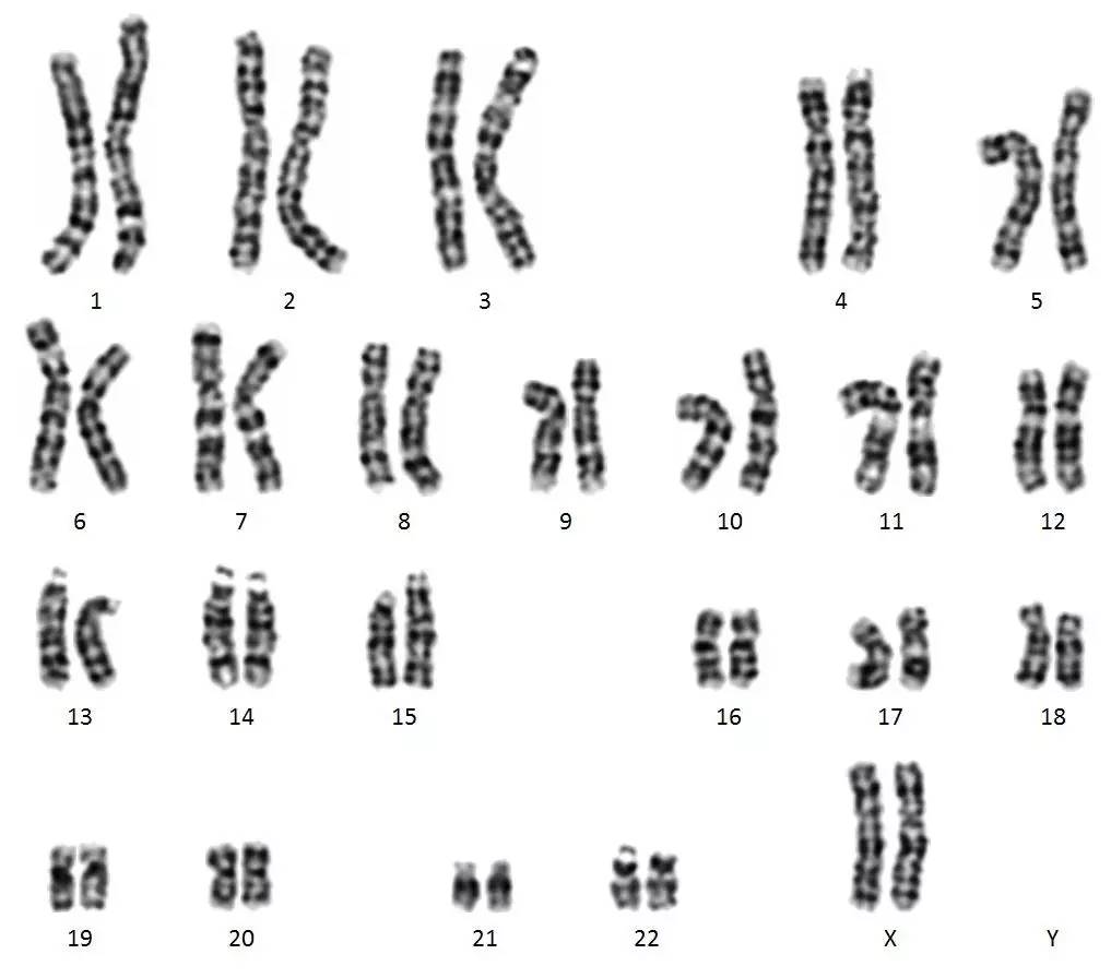 【羊水染色体报告无异常,能不能证明孩子健康】染色体核型虽然是