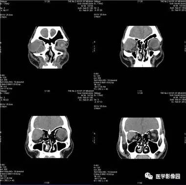 眼眶外侧囊实性占位,等你分析丨读片专栏 511期