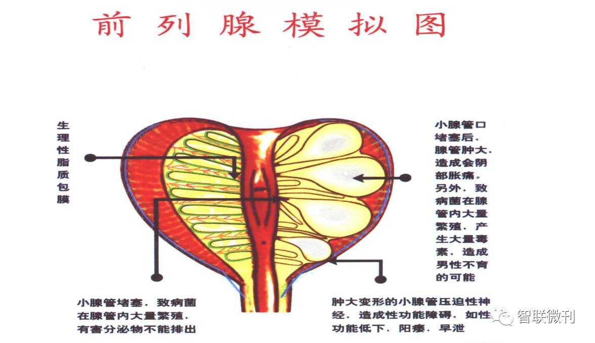 点击图片放大更清晰▼▼▼前列腺内血液回路不通畅,细小的静脉使得