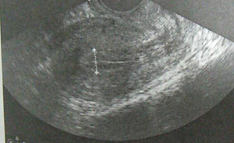 子宫内膜增生超声图片图片