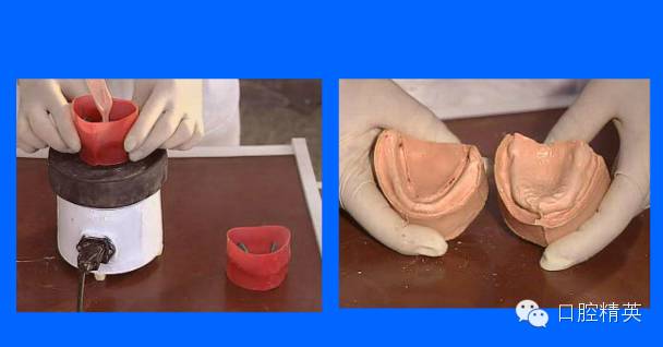 BPS吸附性义齿制作过程图片
