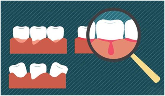 牙齦出血怎麼辦