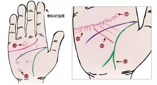 傻眼了掌纹竟可以诊断肝癌糖尿病高血压妇科病脑溢血