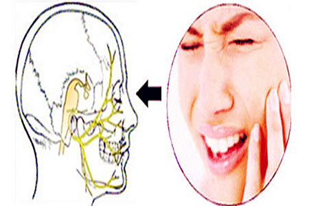 天下第一痛三叉神经痛该怎么治疗?