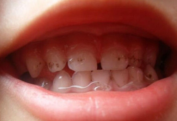 牙齿白垩色的图片图片
