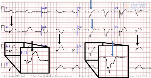 下圖是另外一例心律失常提示心梗的心電圖,可見房室連續起搏和心房