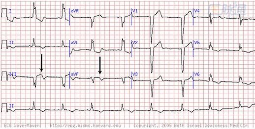 心肌梗死不可錯過的五種心電圖線索的確有用