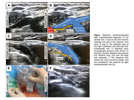 实时超声引导锁骨上入路中心静脉穿刺 另一种选择