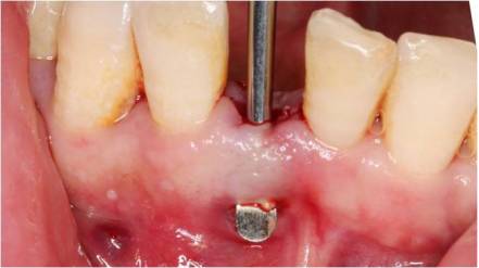 图片5-8:拔除患牙图片9-10 使用骼瑞骨粉填充图片11-12 使用生物膜