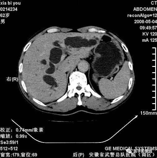 第六章 腹部 第三節 膽管系統病變 六,梗阻性黃疸丨精品連載