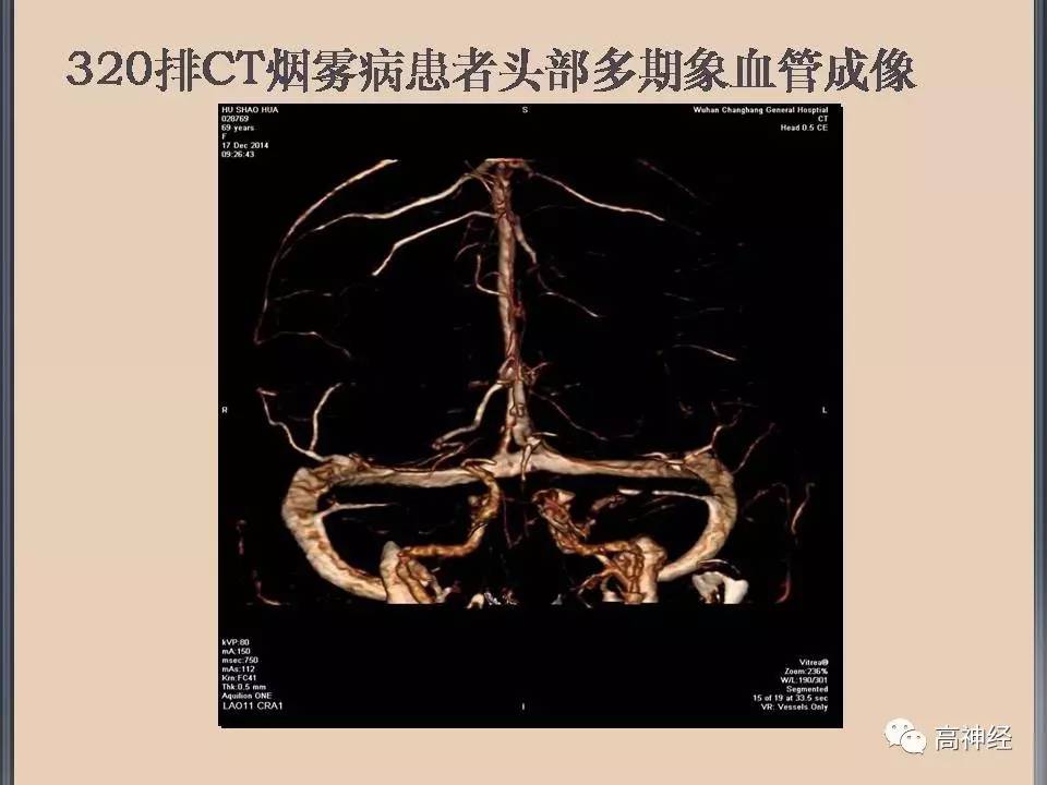 烟雾病的影像与临床