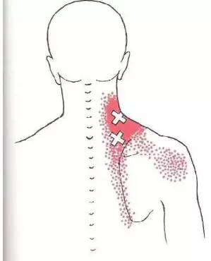 能引起肩胛骨內側緣疼痛的十塊肌肉