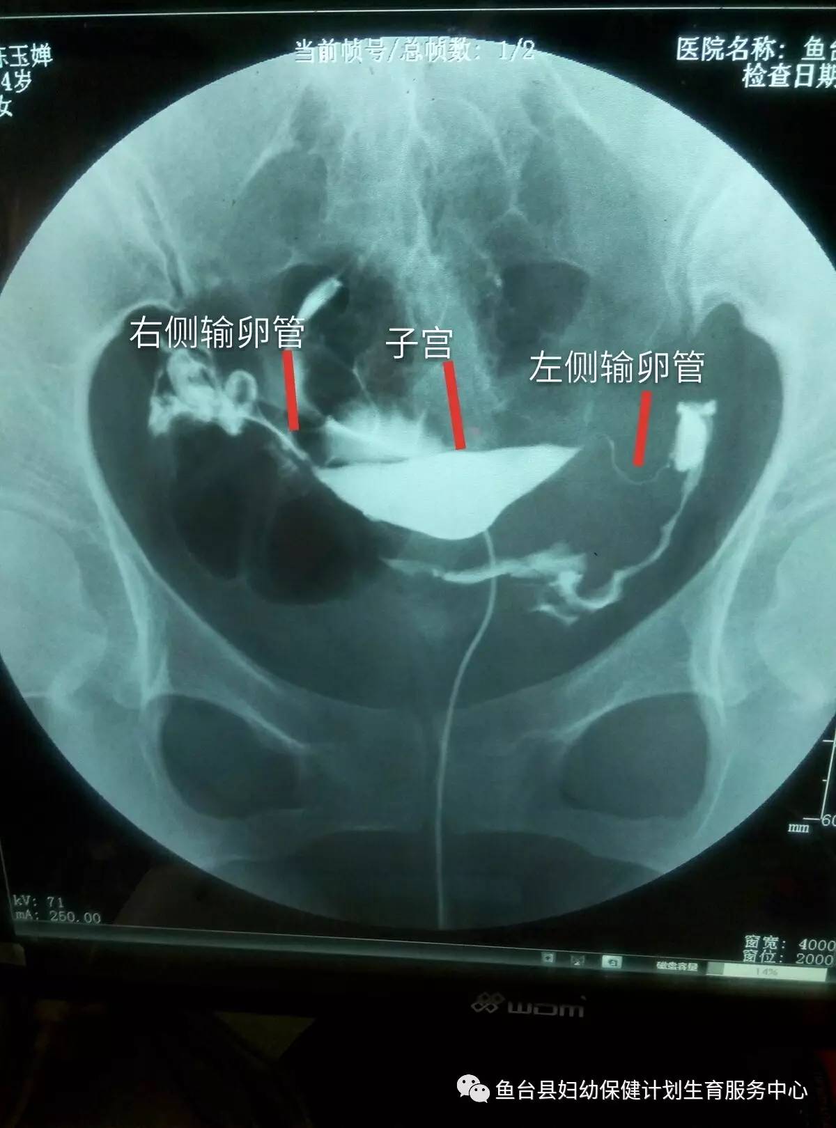 縣婦幼保健院生殖科--怎麼知道輸卵管通不通呢?