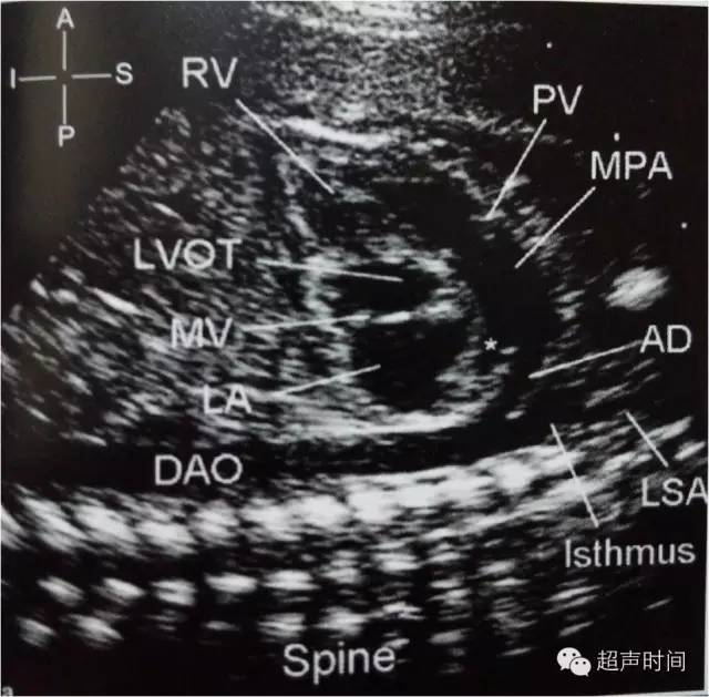 腔静脉长轴这是胎儿胸腔长轴观,显示全身静脉血的引流,即上腔静脉,下