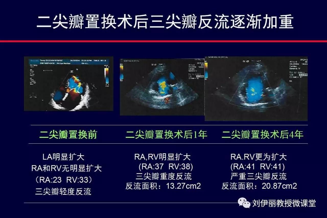 二尖瓣置換術後的三尖瓣關閉不全