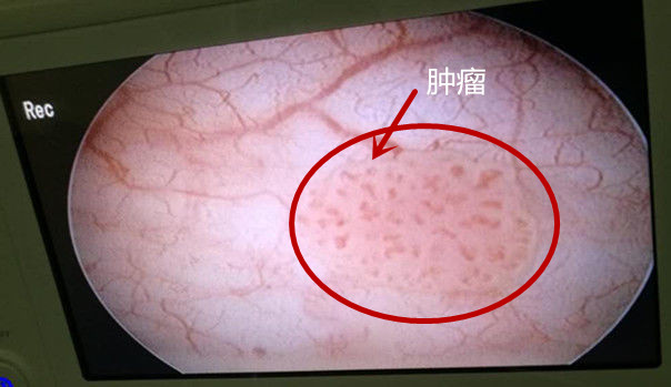 男人膀胱肿瘤图片图片