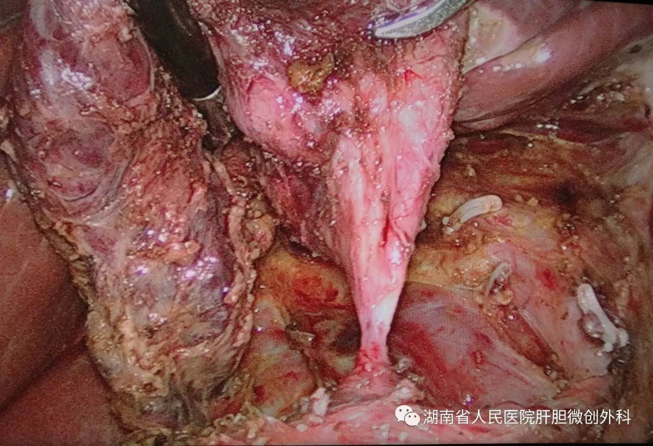 12齡兒童成功行腹腔鏡下巨大先天性膽總管囊腫切除術