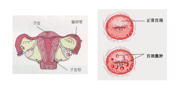 宫颈囊肿是妇科最常见的疾病之一,它是宫颈慢性炎症以后宫颈上腺体的
