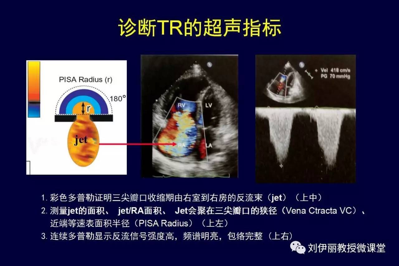 二尖瓣置換術後的三尖瓣關閉不全