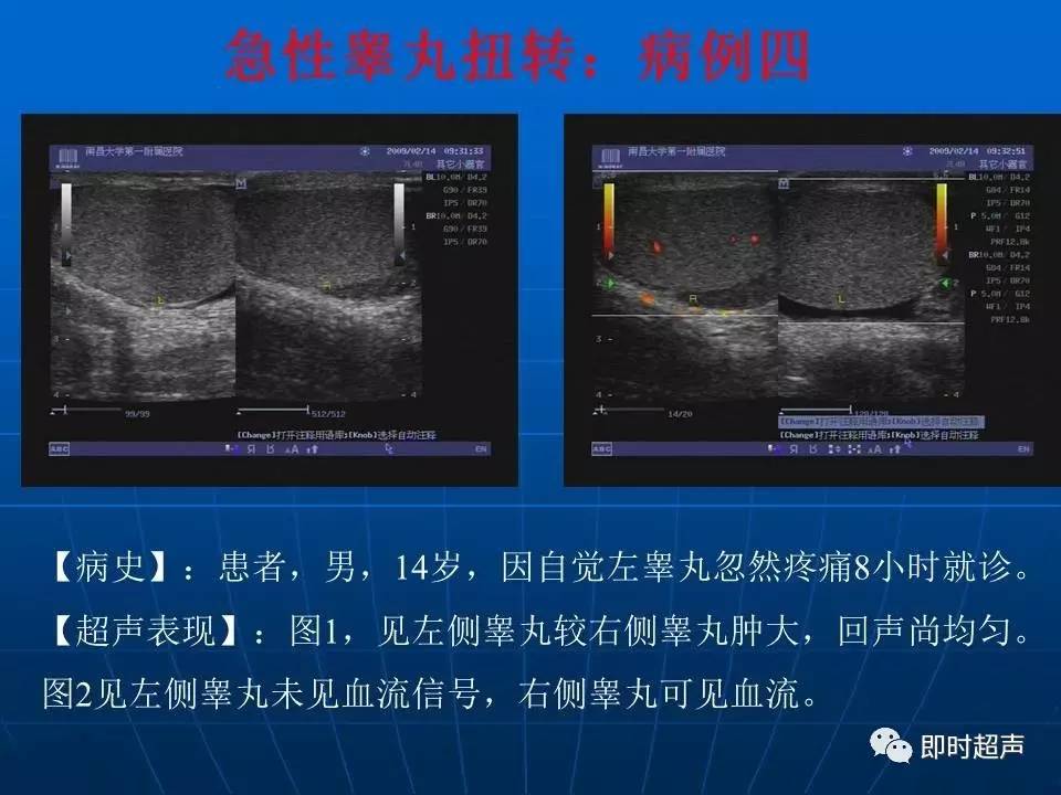 陰囊疾病超聲診斷