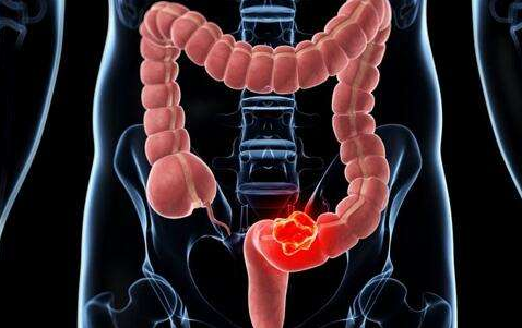 健康 正文另外,据资料显示,国人直肠癌75%以上为低位直肠癌,能在直肠