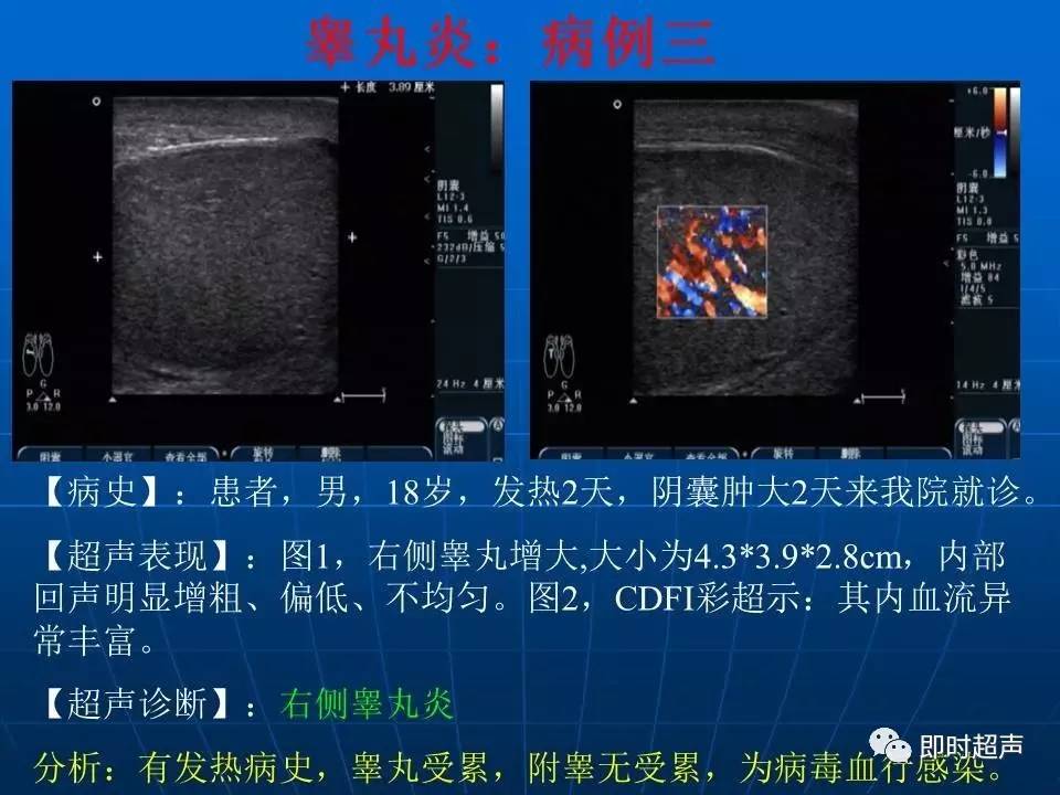 陰囊疾病超聲診斷