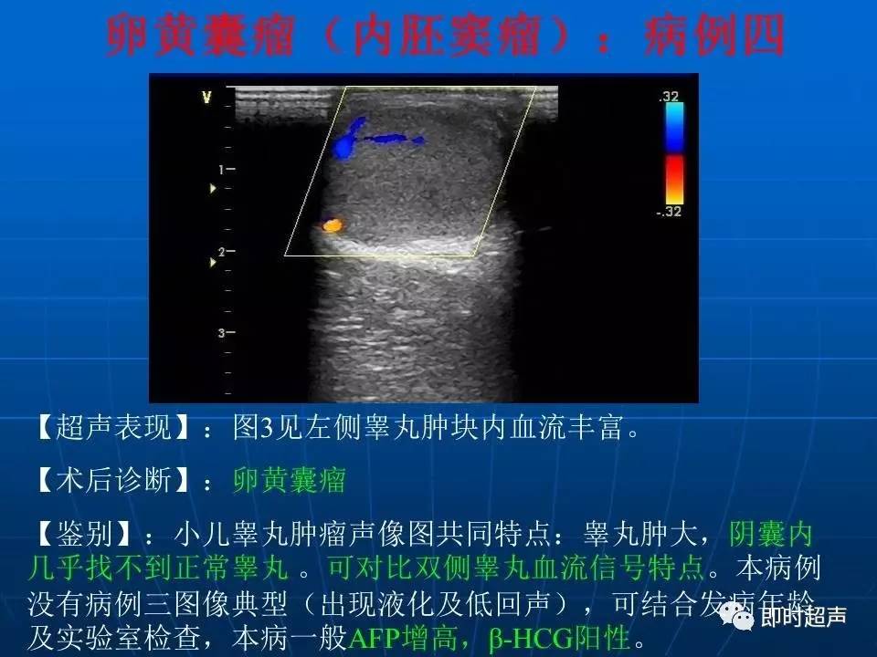 睾丸炎图片彩超图片