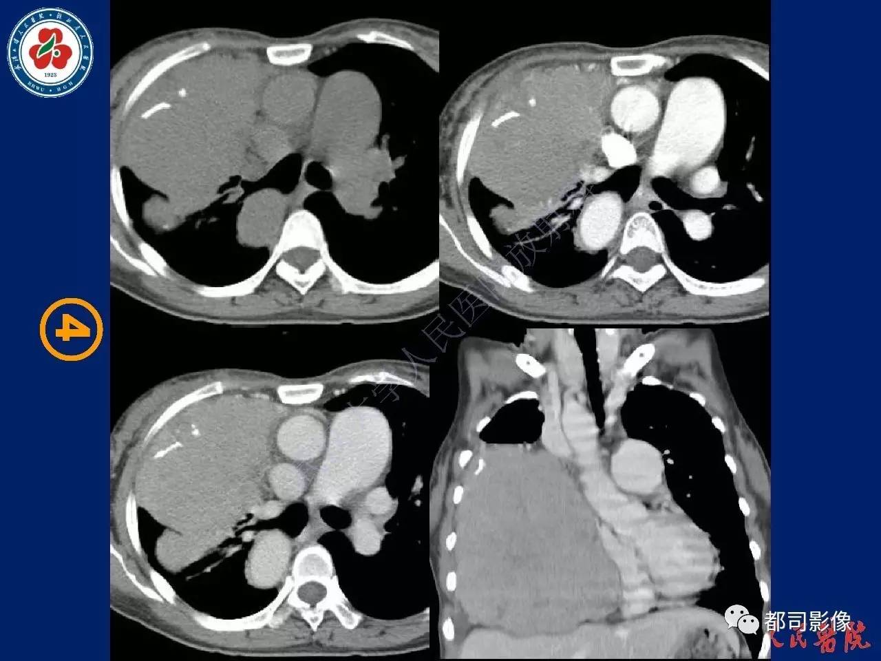 胸腺瘤ct图片
