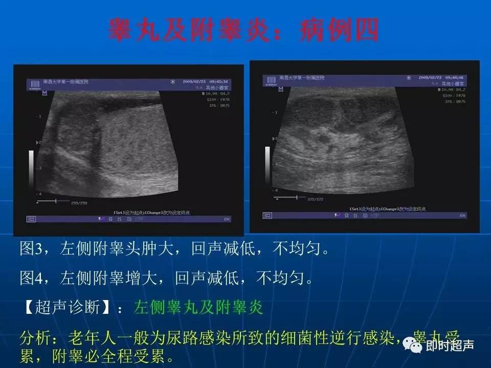 陰囊疾病超聲診斷