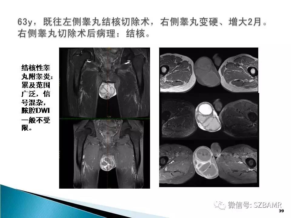 附睾肿瘤图片