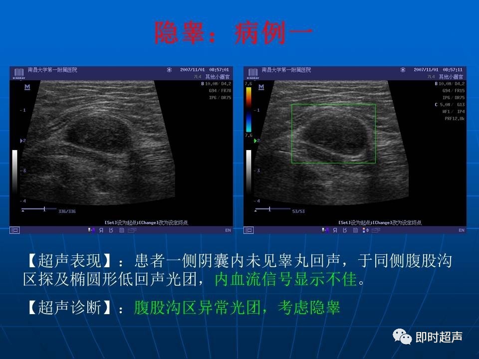 阴囊珠超声图片图片