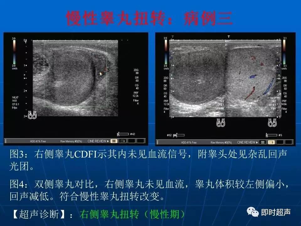 正常睾丸彩超图图片