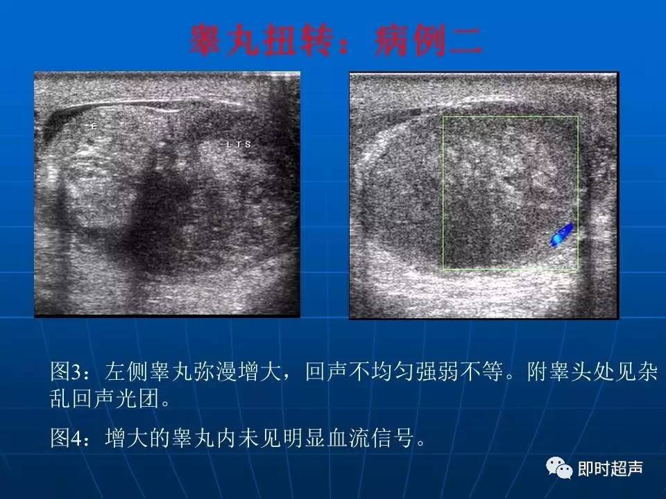 阴囊疾病超声诊断