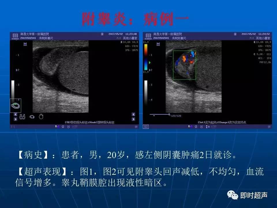 陰囊疾病超聲診斷