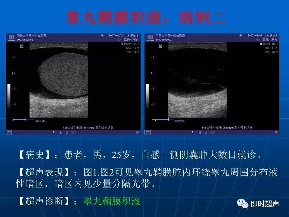 陰囊疾病超聲診斷