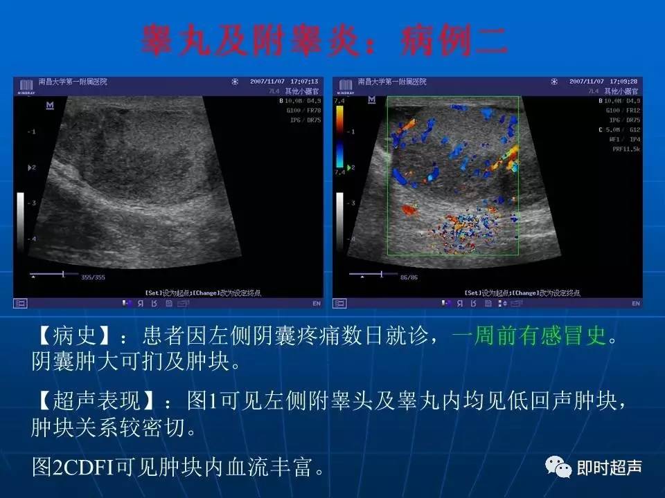 陰囊疾病超聲診斷