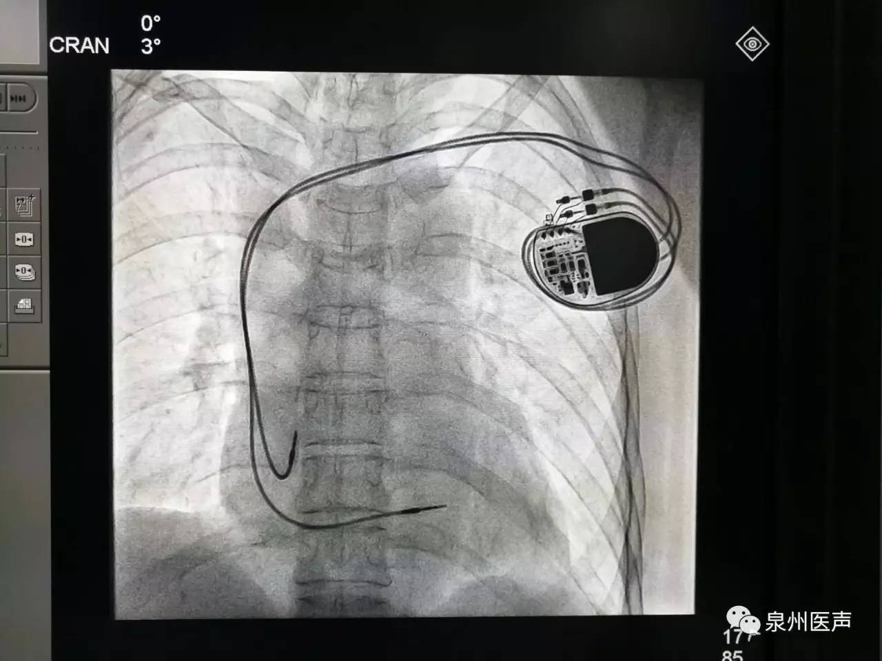 66岁老人心脏长达10秒不跳,晋江市中医院为其装起搏器