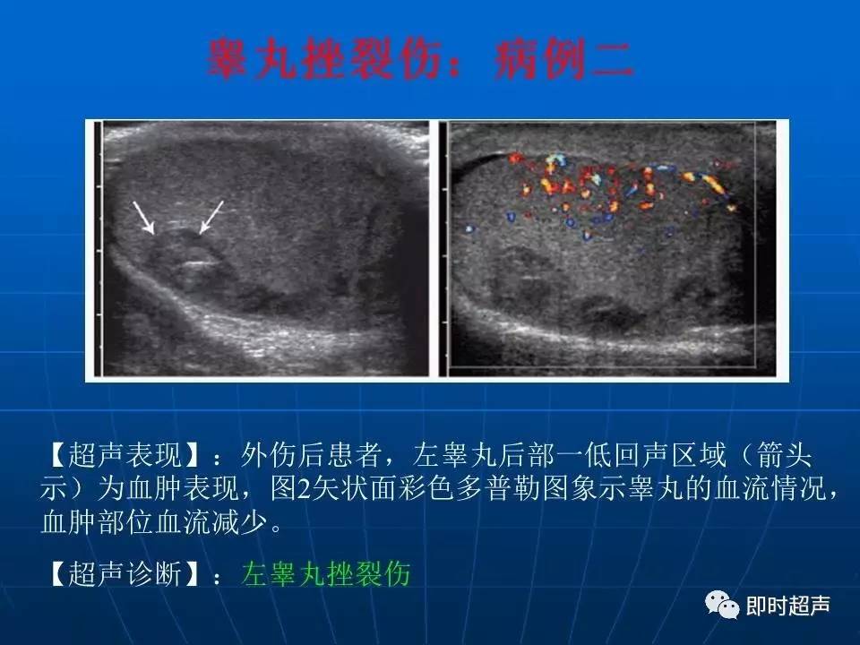 超声诊断阴囊疾病