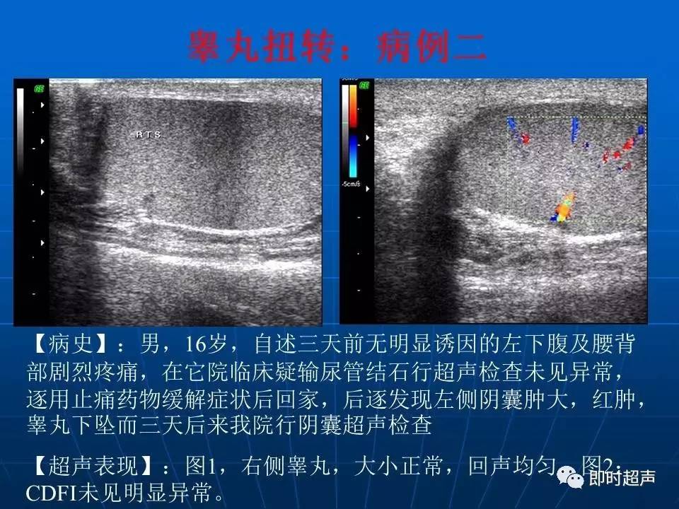睾丸外鞘膜彩超图片图片