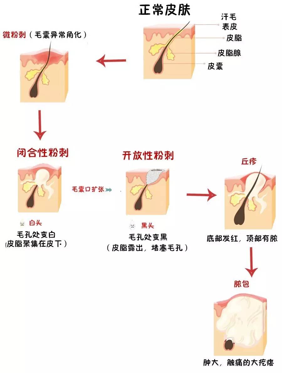 毛孔堵塞長閉口 真正的原因是這些!