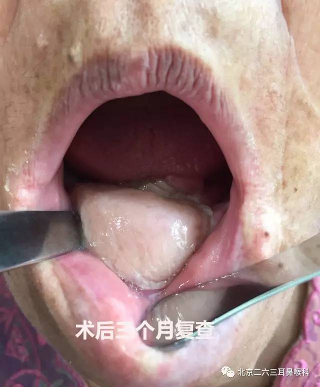 牙龈癌 手术图片