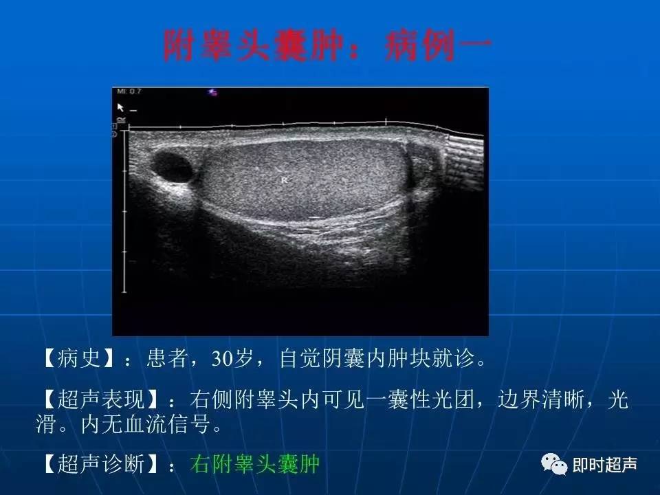 超聲診斷陰囊疾病